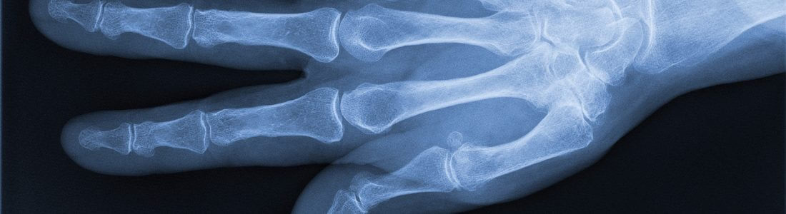 X-ray right hand