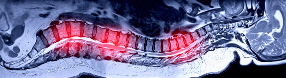 Spinal cord before dorsal root ganglion stimulation