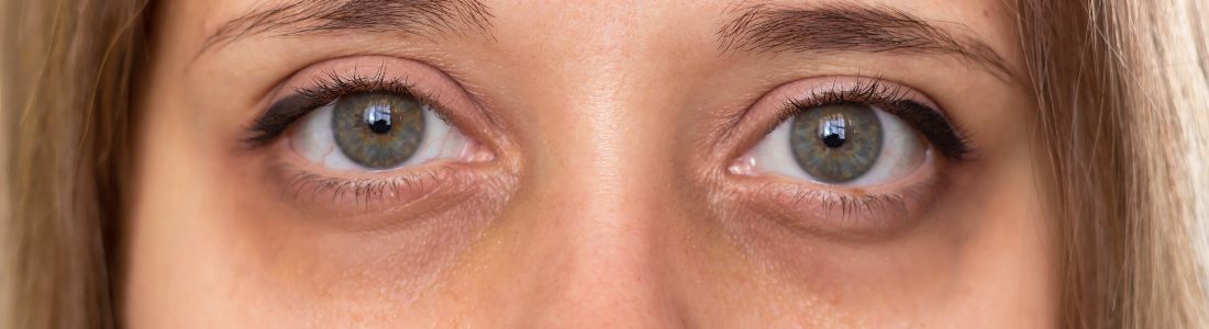 Tired eyes caused by night time restless leg syndrome