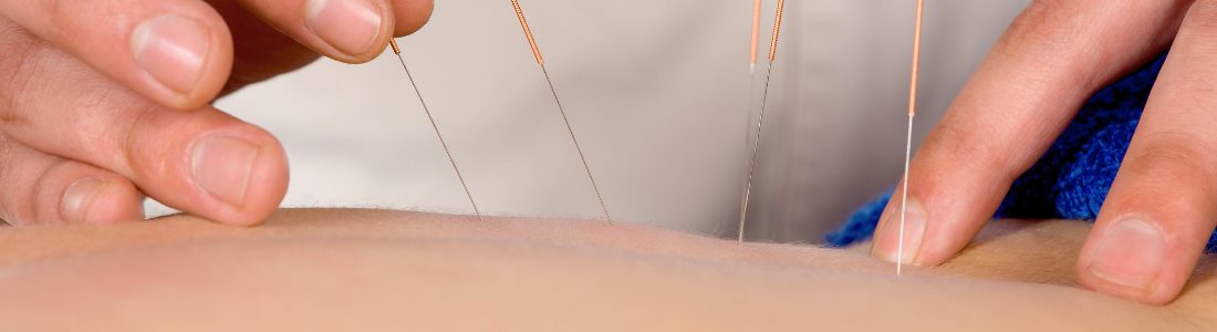 Acupuncture