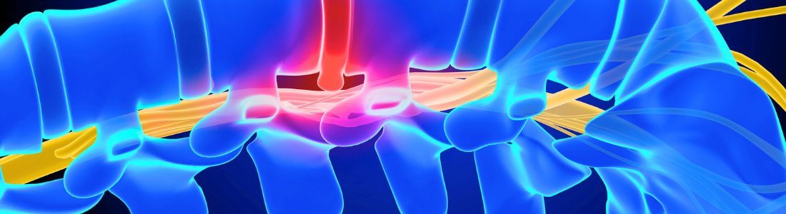 Diagram representing spinal cord stimulation for CRPS