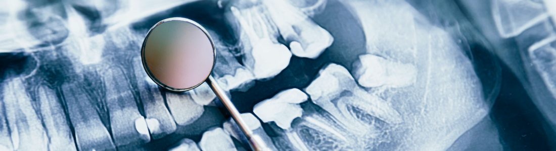 X-ray showing dental problems caused by CRPS